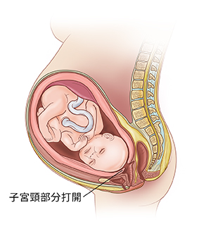 子宮中胎兒側視圖,顯示在早產時開始變薄和張開的子宮頸。