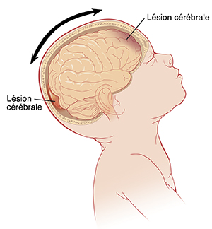 Vue latérale d'un bébé avec la tête inclinée vers l'arrière, montrant le cerveau à l'intérieur. Des flèches indiquent un mouvement d'avant en arrière de la tête, et des lésions à l'avant et à l'arrière du cerveau.